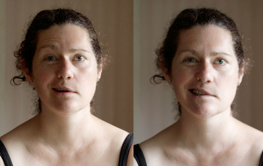The Face of Bell's Palsy: Margaret, raising her eyebrows in surprise (L) and smiling (R)